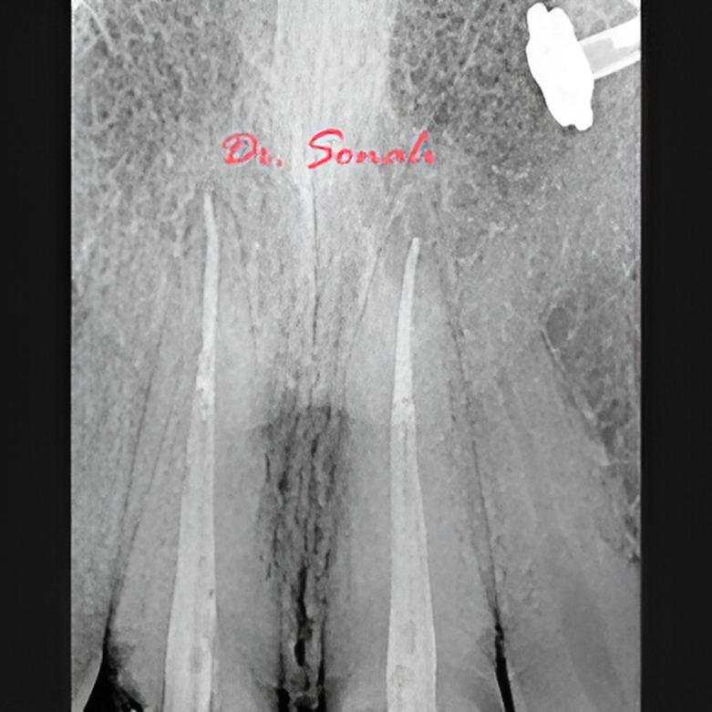 Root Canal Cleaning & Shaping in PCMC – Infection Removal